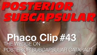 Phaco Clip 43  The WEDGE on Posterior Subcapsular Cataract [upl. by Brott]