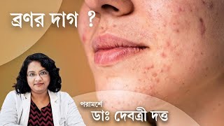 অ্যাকনে মার্কস সারাবেন কিভাবে  Dermatologist suggests treatment for Acne Marks [upl. by Melburn]