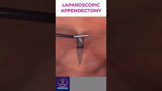 Laparoscopic Appendectomy  Appendicitis Treatment [upl. by Are778]