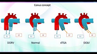 Mastering Fetal Echo in Conotruncal Anomalies [upl. by Janis]