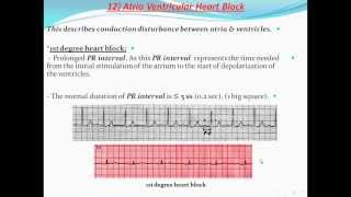 Principles of ECG quotelectrocardiographyquot Part 11 [upl. by O'Hara]