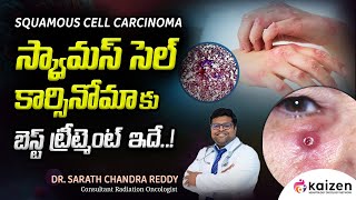 BEST treatment for squamous cell carcinoma  DrSarath Chandra Reddy  Kaizen Hematology Network [upl. by Aylat]