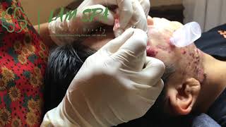 Treatment of acne pustules severe inflammation  Điều trị mụn mủ viêm nặng  LAMSPA PHU QUOC  L P1 [upl. by Hgierb]