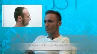 TESTIMONIO REAL DE INJERTO CAPILAR EN CLINICAS BEYOU [upl. by Enirual]