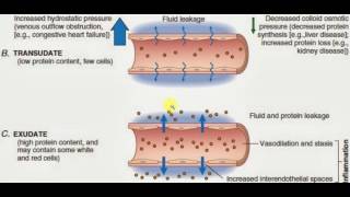 PATHOLOGY LECTURES  Hemodynamic Disorder  EXUDATES and TRANSUDATES [upl. by Orland]