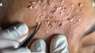 Acne amp Blackhead Treatment Blackhead Removal on forehead  Remove Blackhead removeblackhead [upl. by Estas]