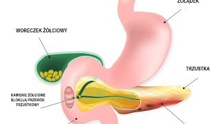 OSTRE ZAPALENIE TRZUSTKI  objawy i leczenie [upl. by Nnylamme]