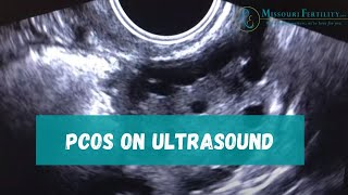 PCOS Sonogram and Discussion [upl. by Nauqaj432]