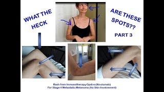 WHAT ARE THESE SPOTS  IMMUNOTHERAPY NIVOLUMAB RASH PART 3 [upl. by Clarhe169]