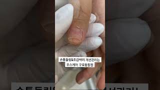 손톱이 떠서 아파요ㅠ손톱이상 개선되다 푸스케어 문제성손톱손톱관리푸스케어구로항동점 [upl. by Head176]