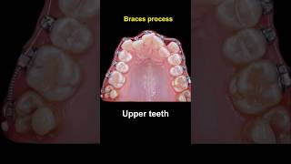 Braces duration  28 months braces orthodontist bracesoff dentist [upl. by Idnir5]