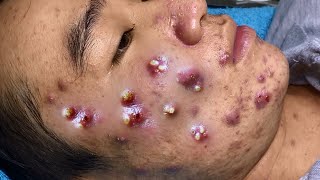 Big Cystic Acne Blackheads Extraction Blackheads amp Milia Whiteheads Removal Pimple Popping 054 [upl. by Saeger401]