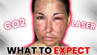 I SURVIVED 3 Fractional CO2 Laser Treatments [upl. by Jago]