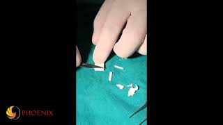 MEGADERM Tip augmentation  Megaderm ចំណិត 1x1cm បង្កើតទម្រងក្បាលច្រមុះ [upl. by Muraida]