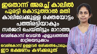 സർജറി ചെയ്തിട്ടും മാറാത്ത വെരികോസ് വെയ്ൻ മാറാൻ ഇത് പുരട്ടിയാൽ മതി vericose vein malayalam [upl. by Latsirc]