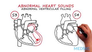 Abnormal Heartsounds and Murmurs Which heart sounds should worry you [upl. by Neuburger]