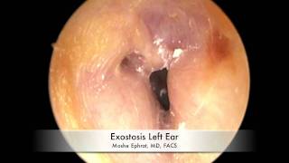 Ear Canal Exostoses [upl. by Natsyrk]