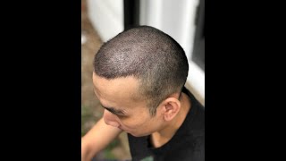 Combining SMP with an FUE Hair Transplant Hair Loss TattooScalp Micropigmentation [upl. by Bealle]