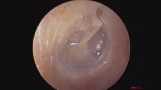 Valsalva Manoeuvre to Normalize Negative Middle Ear Pressure [upl. by Jarrid]