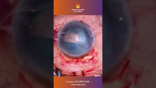 Managing rhexis runoff during Cataract Surgery [upl. by Latsirk743]