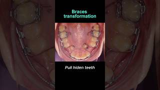 Braces transformation Hiden teeth not problem braces orthodontist dentist dental [upl. by Akinyt]