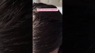 How I get rid of dandruff using a scalp massage brush [upl. by Broddie]