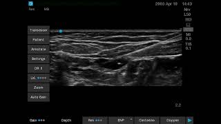 Neonatal QL video 1 [upl. by Artair]