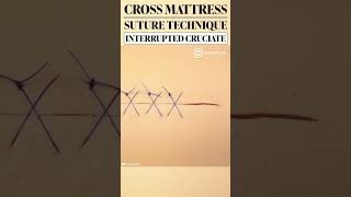 Cross Mattress Suture Technique aka Cruciate shorts education training suture medical surgeon [upl. by Akinorev]