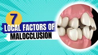 Etiology of malocclusion quotLocal factors of malocclusionquot  Orthodontics [upl. by Neeven]