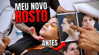 ME OLHEI NO ESPELHO E CHOREI Meu ROSTO após 7 DIAS da CIRURGIA DE FEMINIZAÇÃO 😱 [upl. by Dalpe]