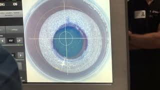 Corneal Tissue Addition Keratoplasty CTAK  CAIRS for Keratoconus [upl. by Urien252]