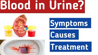 Blood in the urine  Hematuria Types Causes Symptoms Diagnosis Treatment [upl. by Suolhcin]