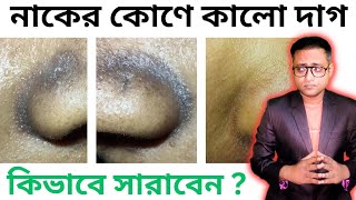 নাকের কোণে কালো দাগ  Black spots around nose  Treatment  Bengali [upl. by Aloel]