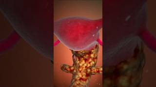 HPV AnimationAnimation of cervical cancercancercervicalviralshortsshortsfeeds [upl. by Esdnil713]