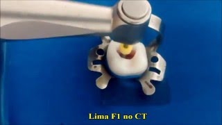 Preparo do Canal Radicular  Sistema Protaper Universal [upl. by Olmsted]