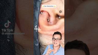 BLACKHEADS IN EAR  Blackhead Removal From Ear shorts [upl. by Haorbed]