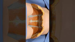 How a tummy tuck removes excess skin 3D Animation [upl. by Justus]