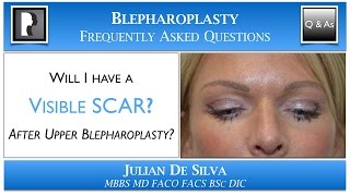 Will I have a Visible Scar after Upper Blepharoplasty Scar after an upper eyelid lift [upl. by Eltsyrhc861]