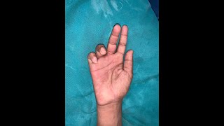 Ulnar Claw Hand Correction [upl. by Selma]