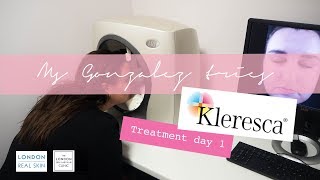 Kleresca Skin Rejuvenation Treatment Day 1 [upl. by Amarette]