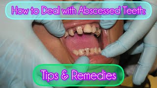 How to Deal with Abscessed Teeth Tips amp Remedies [upl. by Natalia]