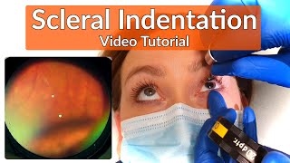 Scleral Indentation  Depression Tutorial [upl. by Kusin]