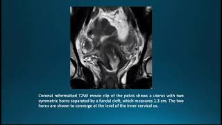 Bicornuate Uterus Case Report and Imaging Features [upl. by Ezmeralda]