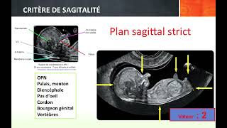 Cours déchographie pour les sagesfemmes partie 1 [upl. by Vince20]