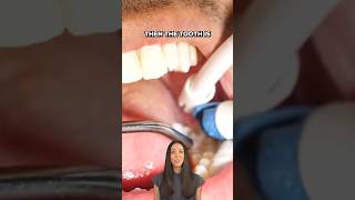 dental sealants procedure shorts [upl. by Lednyk89]