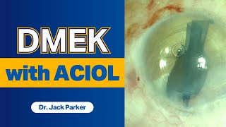 DMEK with ACIOL  Tips and Tricks [upl. by Norina]