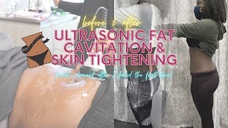 Ultrasonic Fat Cavitation amp Laser Lipo Before and After Review What I Learned After 5 Sessions [upl. by Vod]