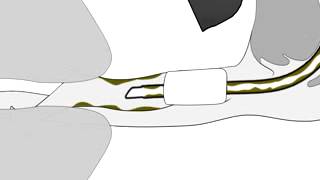 AirWay Medix Closed Suction System [upl. by Dammahum225]