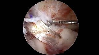 How is a torn Anterior Cruciate Ligament seen on Arthroscopy and How it is reconstructed [upl. by Blatt]