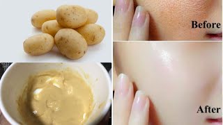 Potato Face Pack For Glowing Skin Pigmentation Acne Scars Clear Skin Beesan face pack [upl. by Eihs]